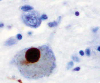 Image: Immunohistochemistry for alpha-synuclein showing positive staining (brown) of an intraneural Lewy-body in the substantia nigra in Parkinson\'s disease (Photo courtesy of the Michael J. Fox Foundation).