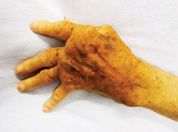Image: Severe rheumatoid arthritis in a hand which was never treated (Photo courtesy of James Heilman, MD).