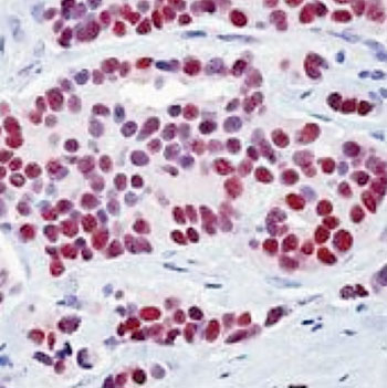 Image: Immunohistochemistry of formalin fixed paraffin-embedded sections from breast carcinoma stained with Estrogen Receptor alpha antibody (Photo courtesy of Abcam).