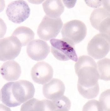 Image: A gametocyte of Plasmodium falciparum in a thin blood smear and also seen are ring-form trophozoites and a red blood cell exhibiting basophilic stippling (Photo courtesy of Dr. Mae Melvin).