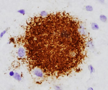 Image: Histopathology of cerebral diffuse beta amyloid plaque (Photo courtesy of Dr. Dimitri P. Agamanolis, MD).