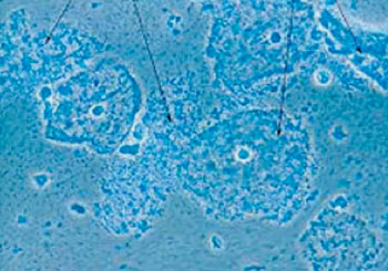 Image: Micrograph of bacterial vaginosis—cells of the cervix covered with rod-shaped bacteria, Gardnerella vaginalis (arrows) (Photo courtesy of Wikimedia Commons).