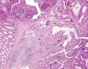 Image: Histologic section of a colonic adenoma containing invasive carcinoma (Photo courtesy of Dr. Mauro Risio).
