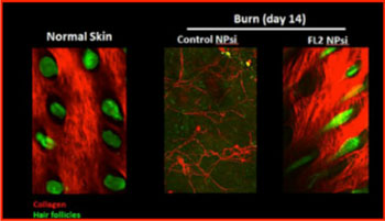 Image: Imaging of burn wounds in mice by confocal microscopy indicates that those treated with FL2 siRNA nanoparticles (far right) experienced collagen deposition and hair follicle formation (Photo courtesy of the Albert Einstein College of Medicine).