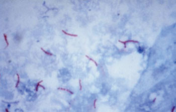 Image: Photomicrograph of Mycobacterium tuberculosis bacteria magnified 1,000 times and colored with acid-fast Ziehl-Neelsen stain Photo courtesy of Emory University).