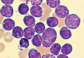Image: Bone marrow aspirate from a child with acute lymphoblastic leukemia shows sheets of blasts which have very scant cytoplasm and nuclei with finely dispersed, dense chromatin without nucleoli, typical appearance of lymphoblasts (Photo courtesy of the Autonomous University of Zacatecas).