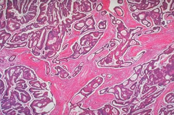 Image: Photomicrograph of a colon carcinoma shows architectural abnormalities that are even more severe than those of an adenoma (Photo courtesy of the University of Washington).