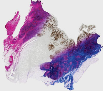 Image: Breast tissue computationally stained using data from infrared imaging without actually staining the tissue, enabling multiple stains on the same sample. From left, the image shows a Hematoxylin and Eosin stain (pink-blue), molecular staining for epithelial cells (brown color) and Masson\'s trichrome (blue, red at right) (Photo courtesy of Prof. Rohit Bhargava).