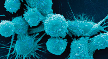Image: Scanning electron micrograph of human prostate cancer cells (Photo courtesy of Dr. Gopal Murti).