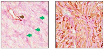 Image: Two adjacent sections of a mouse breast tumor. The tissue at left was stained so that normal blood vessels can be seen (black arrow); extending from these vessels are blood filled channels (green arrows). On the right, the tissue was stained for a fluorescent protein expressed by the tumor cells. Here it is seen that blood-filled channels were actually formed by tumor cells in a process known as vascular mimicry (Photo courtesy of Cold Spring Harbor Laboratory).