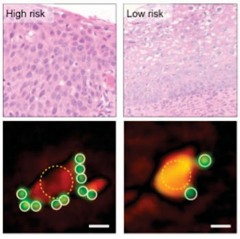 Image: By quantifying the number of tumor-marker-targeting microbeads bound to cells (lower images), the D3 system categorizes high- and low-risk cervical biopsy samples as well as traditional pathology (upper images) does (Photo courtesy of Massachusetts General Hospital).