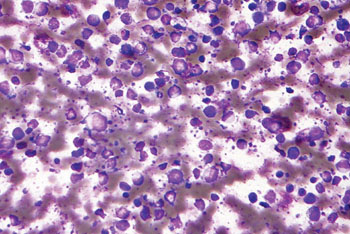 Image: Photomicrograph of a diffuse large B cell lymphoma of a fine needle aspirate specimen from a lymph node (Photo courtesy of Nephron).
