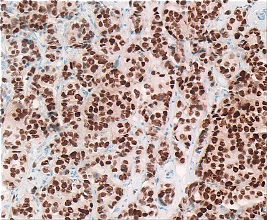 Image: Estrogen receptor (ER)-positive breast cancer surgical pathology specimen stained for ER by immunohistochemistry. Most of the cancer cell nuclei stain dark brown, strongly positive for ER (Photo courtesy of Ronald S. Weinstein, MD).
