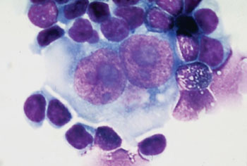 Image: Touch imprint of a binucleated Reed-Sternberg cell ringed by lymphocytes in a classical Hodgkin lymphoma (Photo courtesy of PubCan).