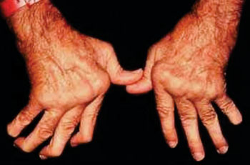 Image: Severe rheumatoid arthritis can destroy the joints and deform the wrist, finger and knuckle joints (Photo courtesy of Cedars-Sinai).