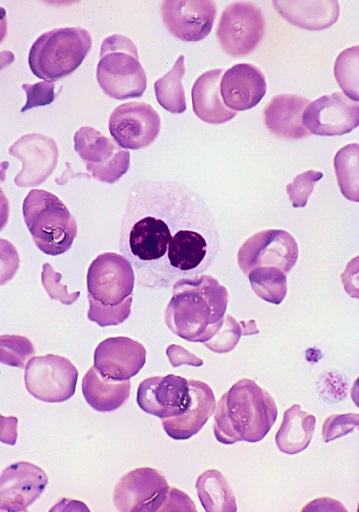 Image: Photomicrograph of a blood film from a patient with myelodysplastic syndrome (MDS) showing a hypogranular neutrophil with a pseudo-Pelger-Huet nucleus and the red blood cells show marked poikilocytosis (Photo courtesy of Armed Forces Institute of Pathology).