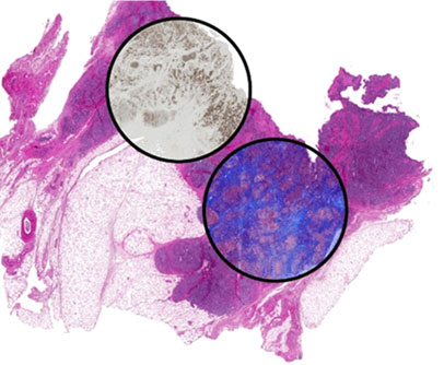 Image: Breast tissue stained to show hematoxylin and eosin (large tissue section). Two regions are selected to show an overlayer of molecular staining (left: cytokeratin; right: Masson\'s trichrome). All 3 stains were computationally generated using chemical imaging data obtained via a newly developed infrared spectroscopic imaging system, and without actually staining the tissue (Image courtesy of Prof. Rohit Bhargava, Beckman Institute for Advanced Science and Technology, University of Illinois at Urbana-Champaign).