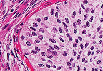 Image: Histopathology of a Brenner tumor, a type of surface epithelial-stromal tumor, which may be benign or malignant, depending on whether the tumor cells invade the surrounding ovarian tissue (Photo courtesy of Nephron).