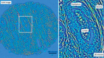 Image: Left: Quantitative phase image of an unstained prostatectomy sample from a patient who had a biochemical recurrence of prostate cancer. Right: A zoomed-in region from the quantitative phase image showing a cancerous gland with debris in the lumen. The stroma, or supportive tissue environment, shows discontinuities in the fiber length and disorganization in the orientation of the fibers (Photo courtesy of the University of Illinois).