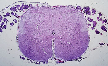 Image: Histopathology of a spinal cord from an infant with multiple joint contractures present at birth (Photo courtesy of Dimitri P. Agamanolis, MD).
