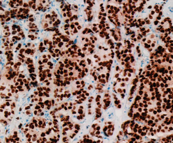 Image: Immunohistochemistry of stained estrogen receptor-positive breast cancer surgical pathology specimen (Photo courtesy of Dr. Ronald S. Weinstein, MD).