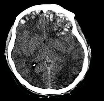 Image: Computed tomography scan (CT) of a patient with brain trauma showing cerebral contusions, hemorrhage within the hemispheres, subdural hematoma, and skull fractures (Photo courtesy of Drs. T. Rehman, R. Ali, I. Tawil, and H. Yonas).