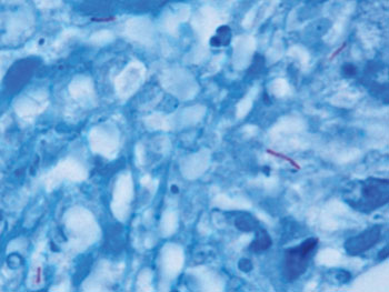 Image: Mycobacterium tuberculosis (stained purple) in a tissue specimen (blue) (Photo courtesy of the CDC - [US] Centers for Disease Control and Prevention).