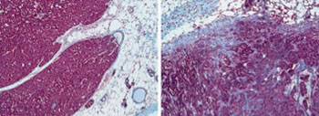 Image: On the left, a breast cancer type called luminal; on the right, a type called triple-negative/basal. The luminal microenvironment has less fibrosis (scar tissue, colored purple) and contains few inflammatory cells embedded within these fibrotic areas or in the surrounding fatty tissue (white). The triple-negative microenvironment contains more inflammatory cells and more fibrosis (Photo courtesy of Egeblad Laboratory, Cold Spring Harbor Laboratory).