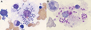 Image: Bone marrow aspiration showing Histoplasma capsulatum (A) and the yeast stained with Periodic Acid Schiff reagent (B) (Photo courtesy of Gareth Gregory and Rose Linda).