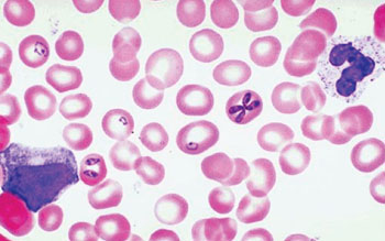 Image: Photomicrograph of a thin blood smear showing different stages of Babesia microti in erythrocytes (Photo courtesy of the University of Utah).