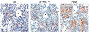 Image: Researchers using RApidCaP, a mouse model of human metastatic prostate cancer, have identified an immune system marker that may help to distinguish patients who will and will not respond to hormone therapy. That marker is IL-6, an immune system component whose presence is indicated in brown patches in the image at left, in a section of lung tissue (blue) colonized by prostate cancer cells. The middle image of the same section of lung tissue indicates activation of STAT3, a protein that is the downstream target of IL-6 signaling. The image at right of the same tissue section demonstrates the presence of PCNA in the invading prostate cells, a marker of metastasis (Photo courtesy of Trotman Laboratory, Cold Spring Harbor Laboratory).