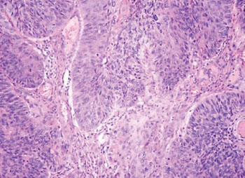 Image: Histopathology of a biopsy smear from a patient with squamous cell carcinoma in the anal canal showing proliferation of atypical cells that infiltrate the stromal (Photo courtesy of Muñiz Hospital).
