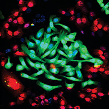 Image: Lung cancer cells (green) are cultured together with normal lung cells (red). The triple-antibody combination EGFR, HER2, and HER3 strongly impairs the survival of tumor cells while sparing normal cells (Photo courtesy of Weizmann Institute of Science).