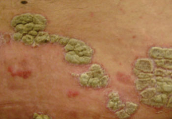 Image: Psoriasis plaques in the skin (Photo courtesy of Wikimedia Commons).