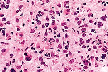 Image: Histopathology of an anaplastic astrocytoma showing marked nuclear pleomorphism. Note the atypical mitosis in the center (Photo courtesy of Dr. Peter C. Burger, MD).