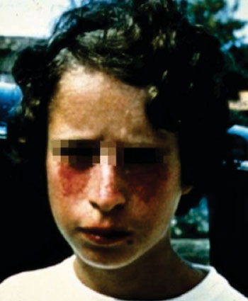 Image: The face of a patient with Bloom syndrome or congenital telangiectatic erythema, a rare autosomal recessive disorder (Photo courtesy of Dr. Amira M. Elbendary).