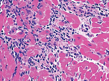 Image: Histopathology of interstitial edema in a cardiac transplant biopsy may be a sign of antibody-mediated rejection (Photo courtesy of the Society for Cardiovascular Pathology).