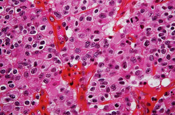 Image: Histopathology of an oligodendroglioma showing the characteristic branching, small, chicken wire-like blood vessels and fried egg-like cells, with clear cytoplasm and well-defined cell borders (Photo courtesy of Nephron).