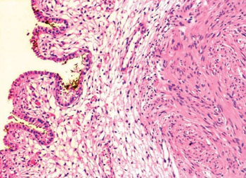 Image: Histopathology of a benign sub-pleural lung nodule showing spindle cell lesion morphology (Photo courtesy of Aga Khan University Hospital).