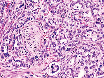 Image: Histopathology of pancreatic adenocarcinoma arising in the pancreas head region (Photo courtesy of Dr. KGH/Wikimedia).