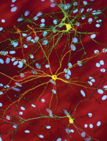 Image: A photmicrograph of medium spiny neurons (yellow) with nuclear inclusions (orange), which occur as part of the Huntington\'s disease process. Several neurons are colored yellow and have a large central core with up to two dozen tendrils branching out of them. The core of the neuron in the foreground contains an orange blob about a quarter of its diameter (Photo courtesy of Wikimedia Commons).