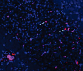 Image: Photomicrograph shows dying insulin-secreting cells (red) from a diabetic mouse pancreas. A cell-death cascade was set off by a process that occurs when harmful molecules spill from one part of the cell into other areas where they do not belong (Photo courtesy of Dr. Fumihiko Urano, Washington University School of Medicine).