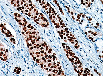 Image:  Histochemistry of progesterone receptor (PR) positive breast tumor (Photo courtesy of Biocare Medical).