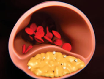 Image: Results presented in this study suggest that the enzyme CD39 can suppress the plaque buildup that may trigger heart attack or stroke (Photo courtesy of the University of Michigan).