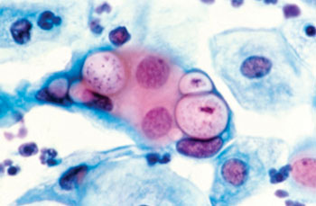 Image: Human pap smear showing H&E stained Chlamydia in the vacuoles (500x) (Photo courtesy of the [US] National Cancer Institute).