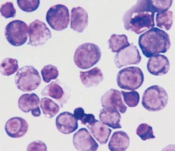 Image: Photomicrograph showing acute myeloid leukemia (AML) cells (Photo courtesy of the University of California, San Diego).