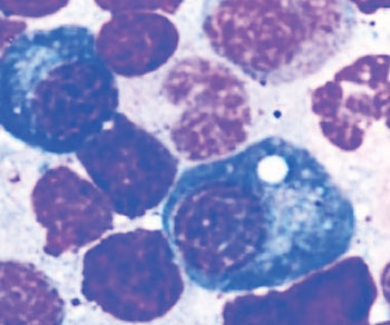 Image: Long-lived plasma cells have a distinctive \"fried egg\" appearance, containing bubble-like vacuoles or lipid droplets, which are generally rare in bone marrow cell samples (Photo courtesy of Emory University).