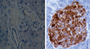 Image: A representative image of islets from diabetic mice, which did not receive IL-35 (left) and received IL-35 (right). The brown color represents insulin producing beta cells. New research showed progress in the use of the anti-inflammatory cytokine for treatment of Type I diabetes (Photo courtesy of Dr. Kailash Singh, Uppsala University).