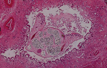 Image: Histopathology of an adult Southeast Asian liver fluke Opisthorchis viverrini in an intrahepatic bile duct, a predisposing condition for intrahepatic cholangiocarcinoma (Photo courtesy of the International Agency for Research on Cancer).