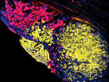 Image: Multicolored metastasis in the peritoneal lining of the abdomen comprised of red and yellow fluorescent cells demonstrating that pancreatic cancer spreads through interactions between different groups of cells (Photo courtesy of Dr. Ravi Maddipati, University of Pennsylvania).